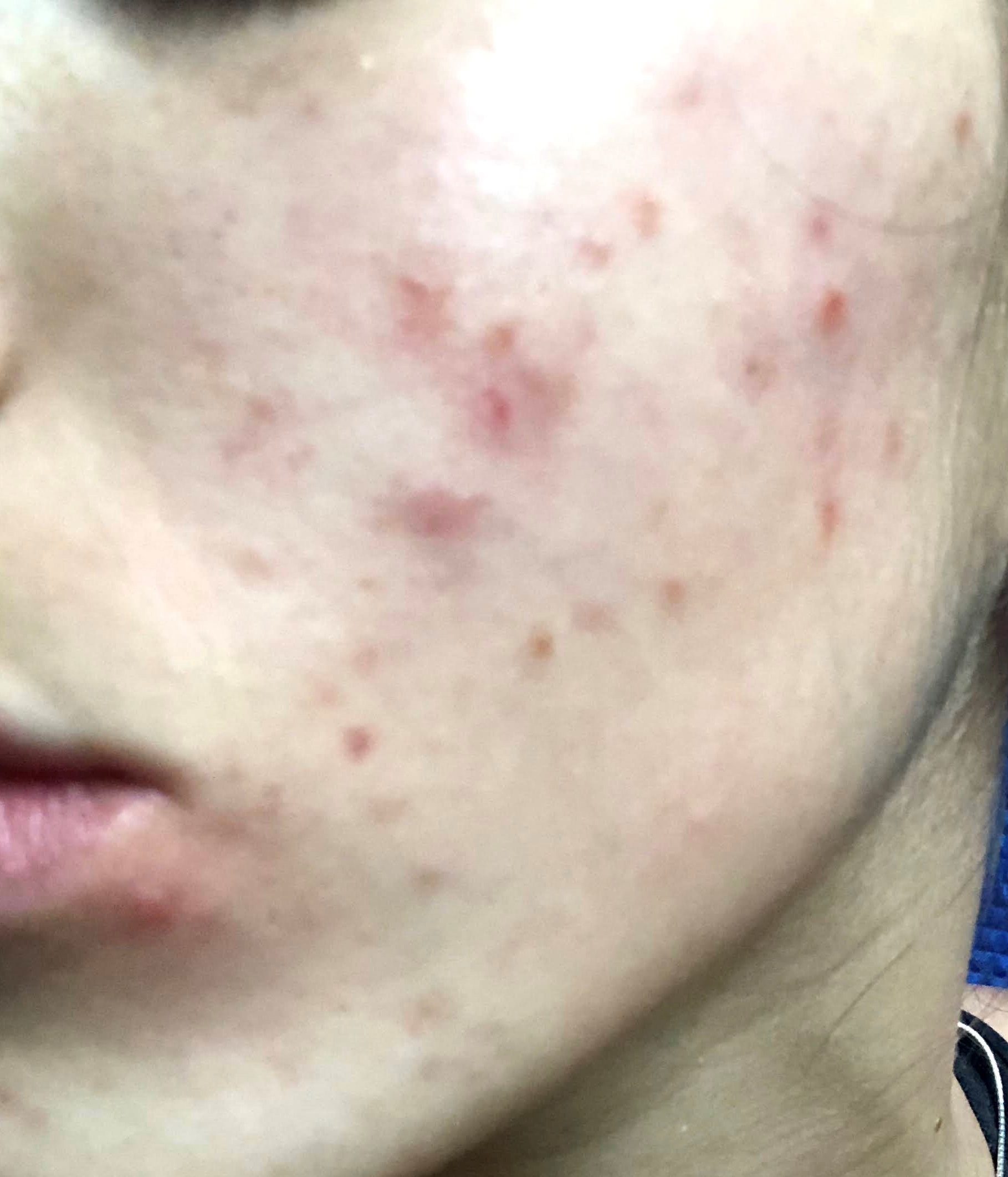 Casos de Acné - Antes y Después de Luz pulsada